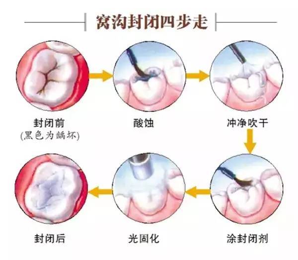 龋怎么读,龋齿怎么读